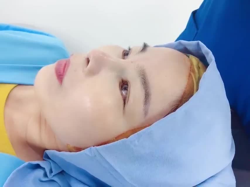 Cận cảnh Cố định dáng mũi cho khách hàng sau khi Nâng mũi Model 4D tại BVTM Đông Á