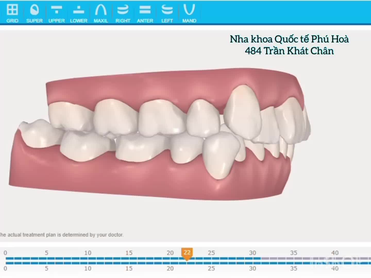 case răng khấp khểnh nhiều, hàm không đều.