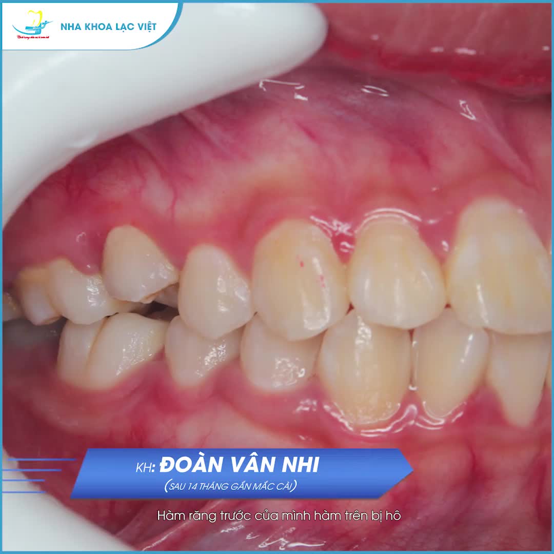 Chẳng cần đến phép màu, chỉ cần niềng răng mắc cài, bạn khách hàng NK Lạc Việt đã lột xác thần tốc hàm răng hô, khấp khểnh trở nên đều đặn chỉ sau 18 tháng.