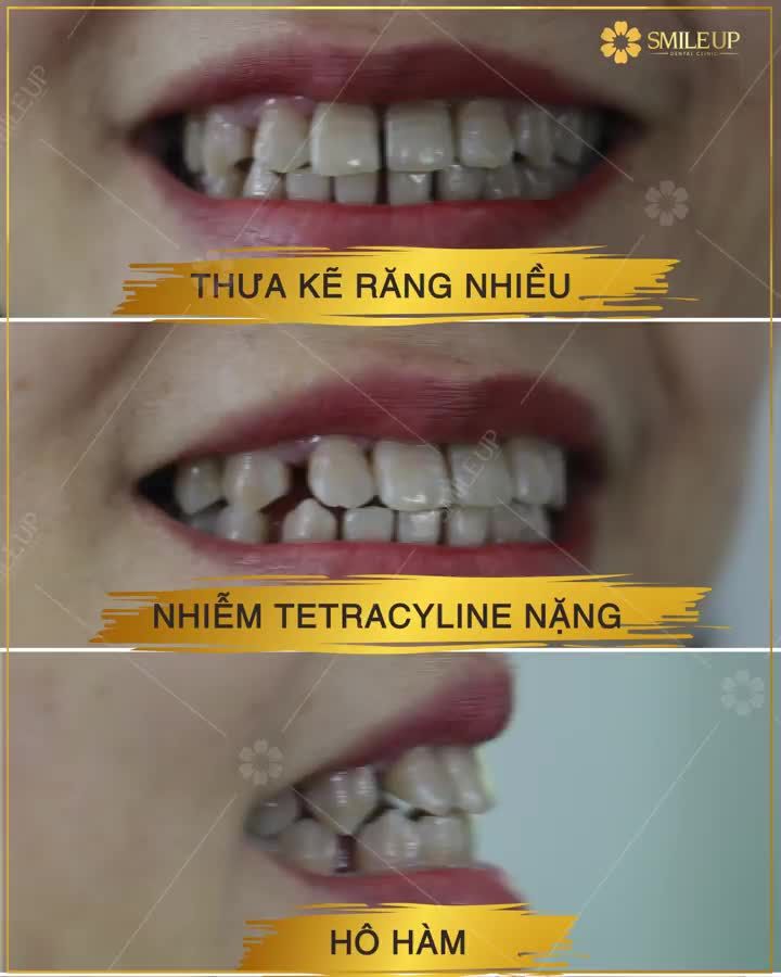 "Không chỉ là VUI mà còn VÔ CÙNG HÀI LÒNG khi làm răng tại Smile UP"
