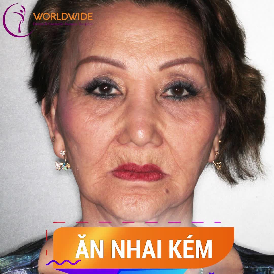 MẤT MỘT RĂNG - MẤT NHIỀU RĂNG - MẤT TOÀN HÀM