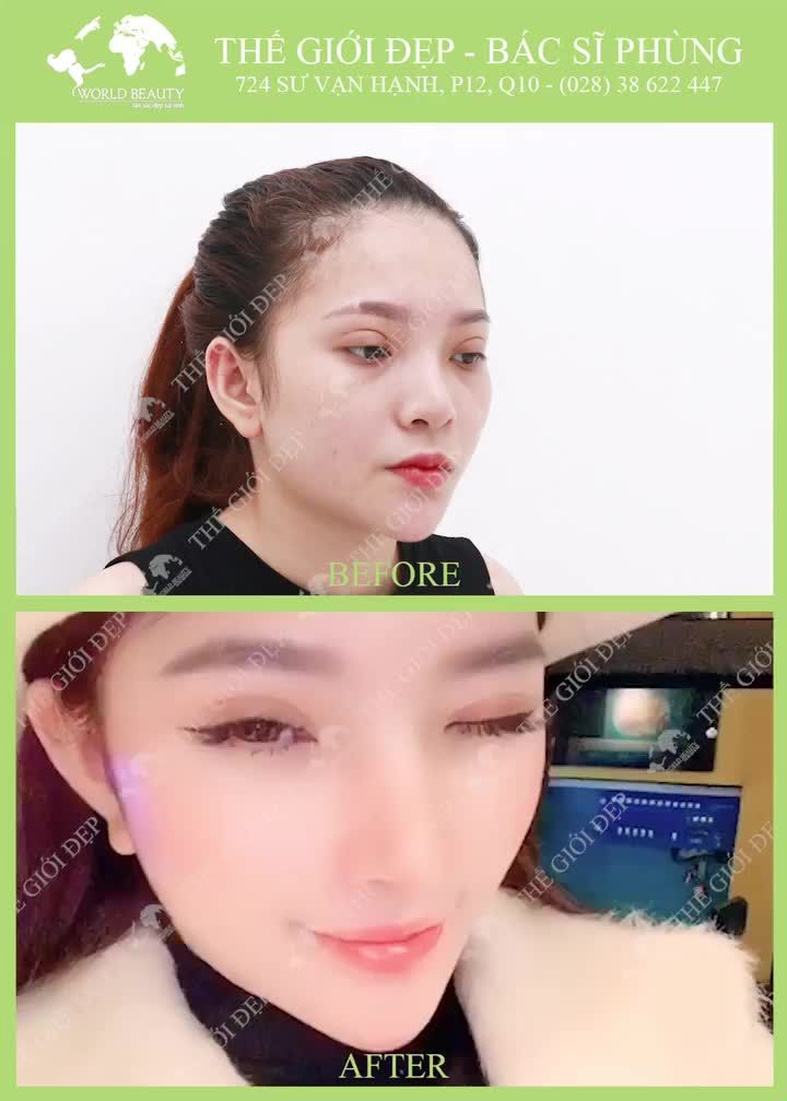 MŨI ĐẸP TỰ NHIÊN - THÁCH THỨC MỌI GÓC NHÌN