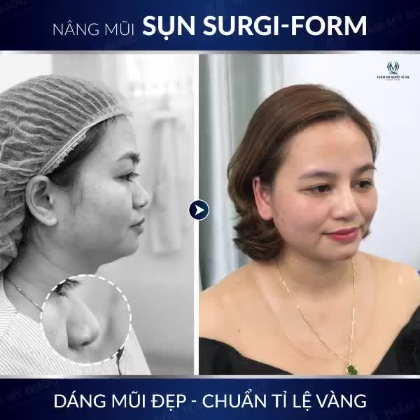NÂNG MŨI SỤN SURGIFORM - XU HƯỚNG NÂNG MŨI THỜI THƯỢNG