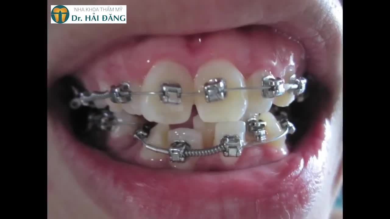 NIỀNG RĂNG KỸ THUẬT CAO - KHẮC PHỤC MỌI KHIẾM KHUYẾT VỀ RĂNG