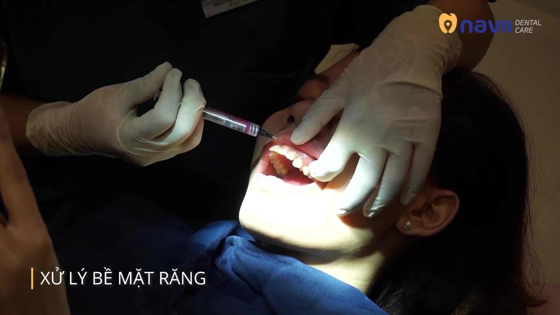 QUÁ TRÌNH GẮN MẮC CÀI DIỄN RA THẾ NÀO