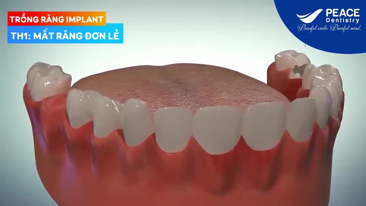 TRỒNG RĂNG IMPLANT – GIẢI PHÁP TRỒNG RĂNG GIẢ ƯU VIỆT, HIỆN ĐẠI