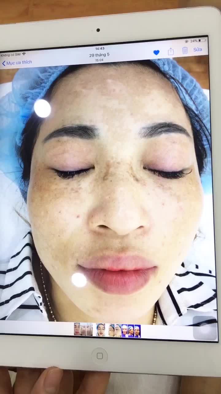 QUÁ TRÌNH TRỊ NÁM của khách hàng U40