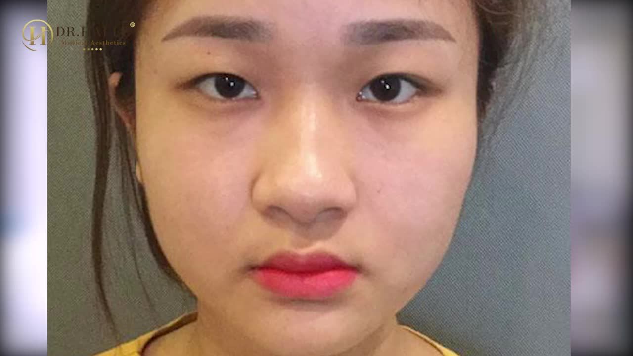 KH NGỌC MINH - CV nhân viên Spa: "Mình cắt mí KHÔNG ĐAU, còn tưởng chưa làm!"