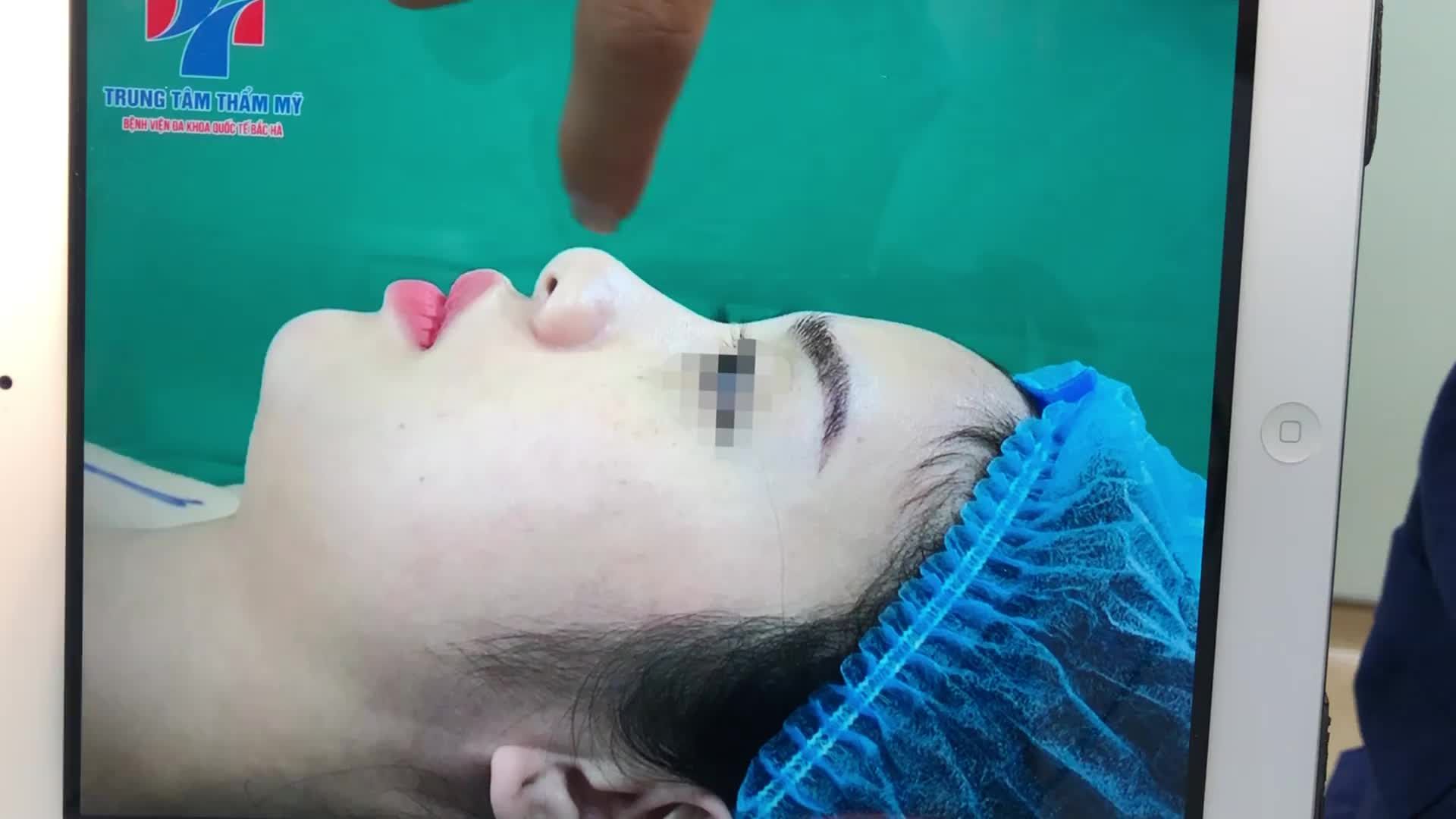 NÂNG MŨI CẤU TRÚC chất liệu cao cấp SOFXiL