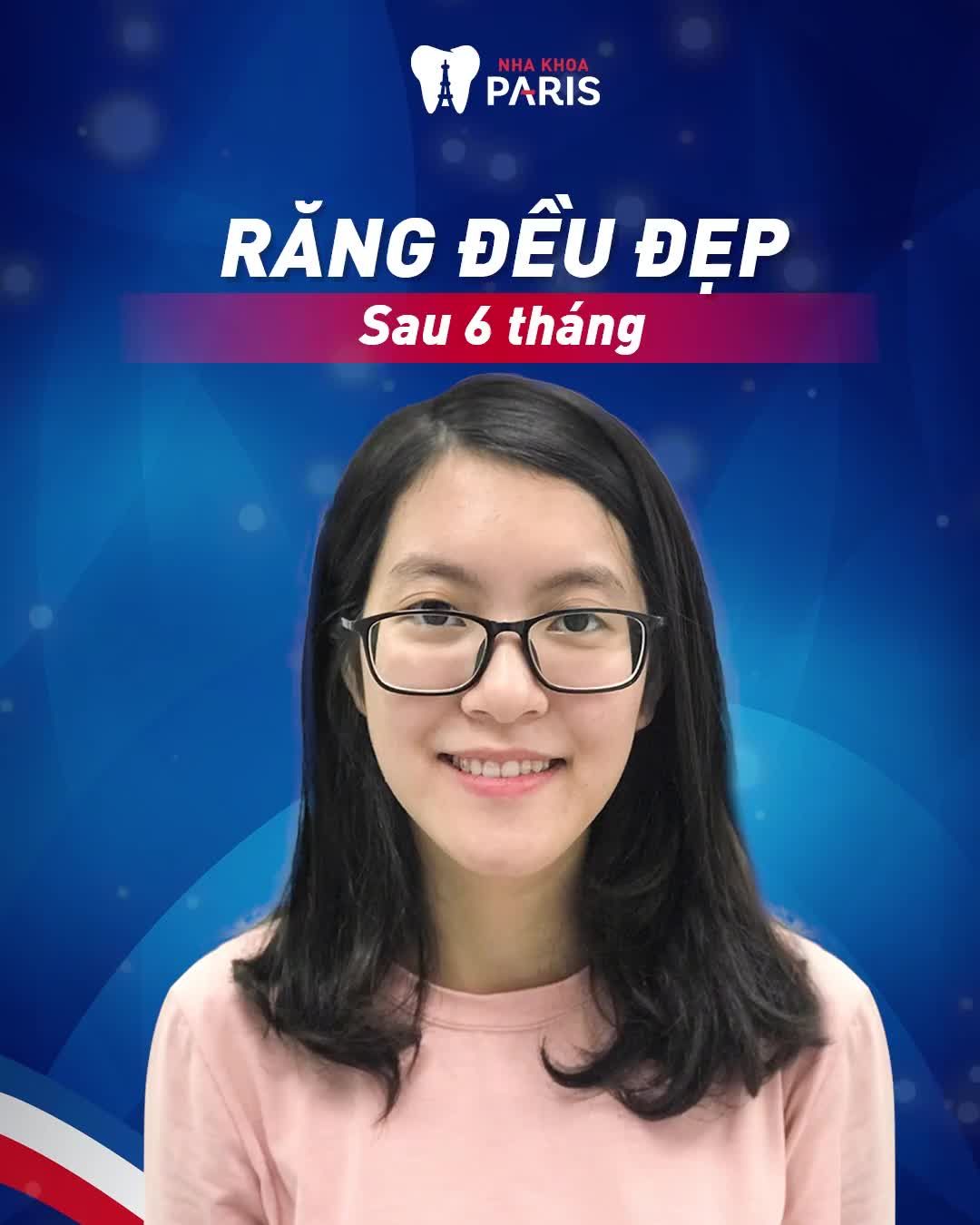 OFF 20% NIỀNG RĂNG THÁNG 10 - RĂNG ĐỀU ĐẸP CHỈ TỪ 15 TRIỆU