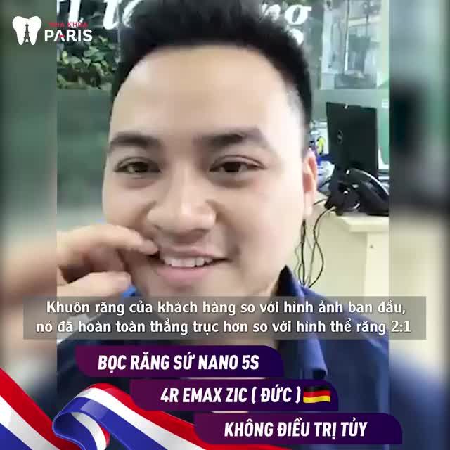 Răng Cửa Hết Khấp Khểnh - Chuẩn Tỷ Lệ Vàng nhờ Bọc Sứ