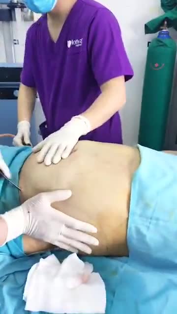 Bụng mỡ siêu to khổng lồ của 1 anh khách hàng thực hiện dịch vụ hút mỡ bụng bằng công nghệ Vaser lipo Dr Hoàng Tuấn