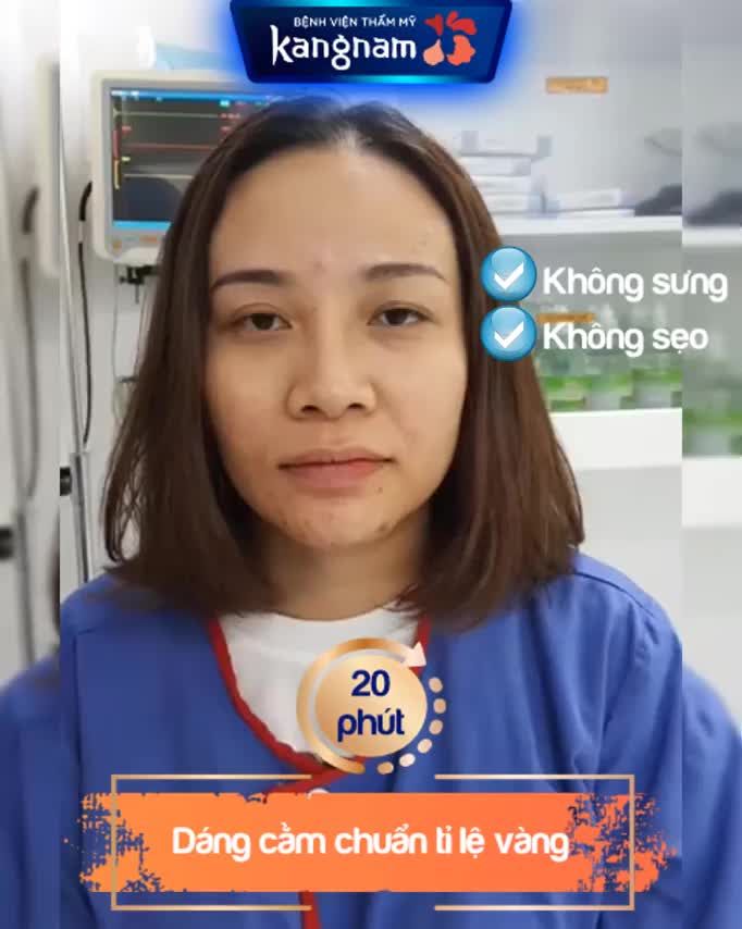 Cằm vừa độn xong đã lên form ưng quá các chị ơi