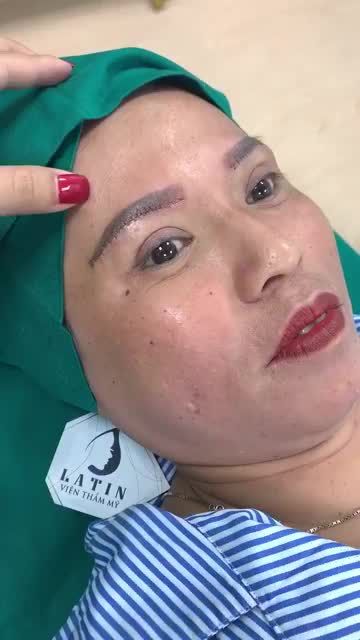 Không còn mắt sụp, mắt buồn sau khi nâng cung mày