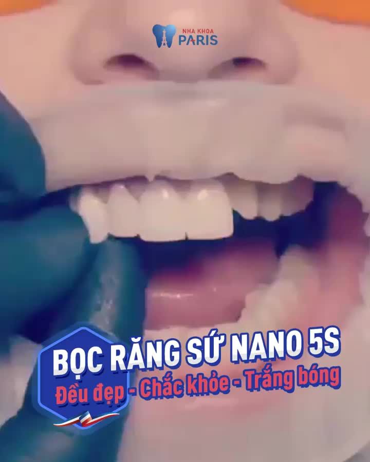 Cận cảnh quy trình gắn răng hoàn thiện một ca răng sứ thẩm mỹ toàn hàm