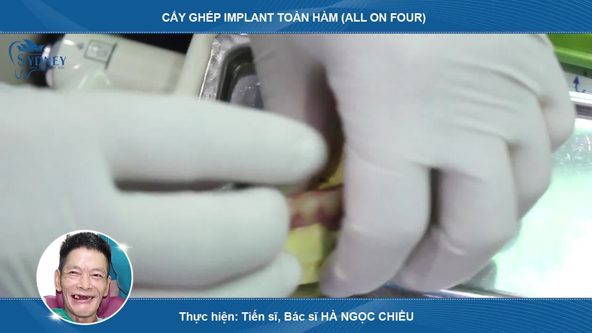 Case phục hình, sau cấy ghép implant toàn hàm All on four cho bệnh nhân T. V. T - 56 tuổi ở Hưng Yên