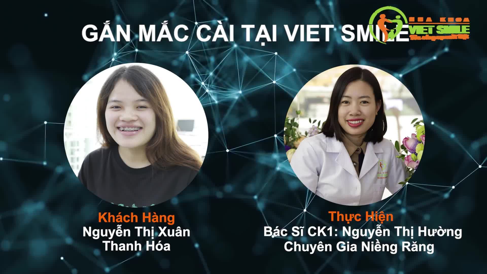 GẮN MẮC CÀI CHỈ LÀ CHUYỆN NHỎ