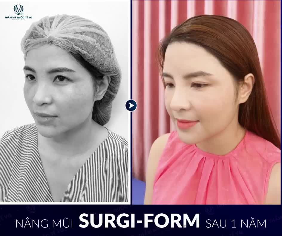 KẾT QUẢ NÂNG MŨI SỤN SURGI-FORM SAU 1 NĂM