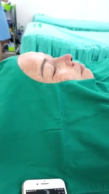 Nâng mũi Sform cuộn cánh cho khách hàng t0 tuổi