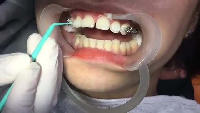 Tại sao phải niềng răng hô