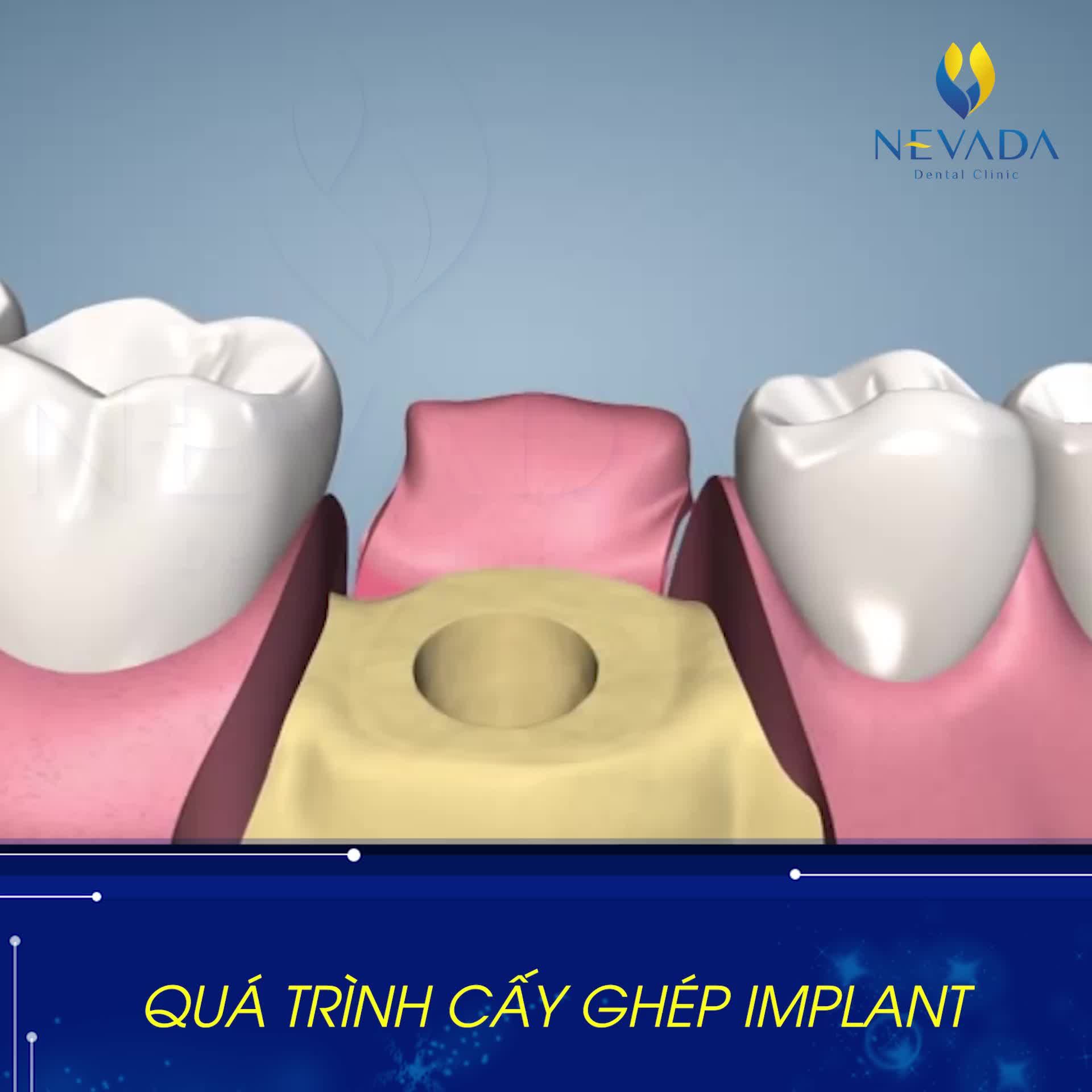 TRỒNG RĂNG IMPLANT DIỄN RA NHƯ THẾ NÀO