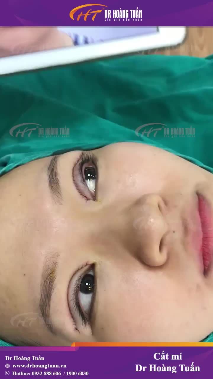 Zoom thật sát đôi mắt vừa thực hiện xong dịch vụ cắt mí tại Dr Hoàng Tuấn cho các chị em cùng tham khảo