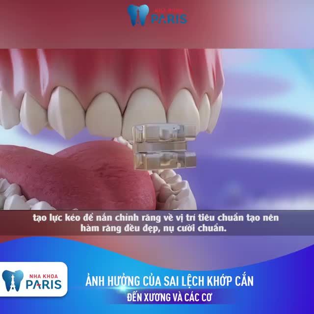 TRÌ HOÃN KHÔNG NIỀNG RĂNG - HẬU QUẢ KHÓ LƯỜNG