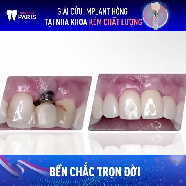 CHUYÊN KHOA TRỒNG RĂNG IMPLANT TIÊU CHUẨN PHÁP