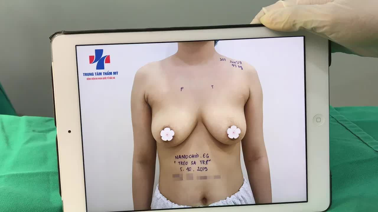 TREO SA TRỄ  ĐẶT TÚI là phương pháp mà ekip các bác sĩ Thẩm mỹ bệnh viện Bắc Hà đã thực hiện cho chị khách hàng 26 tuổi.