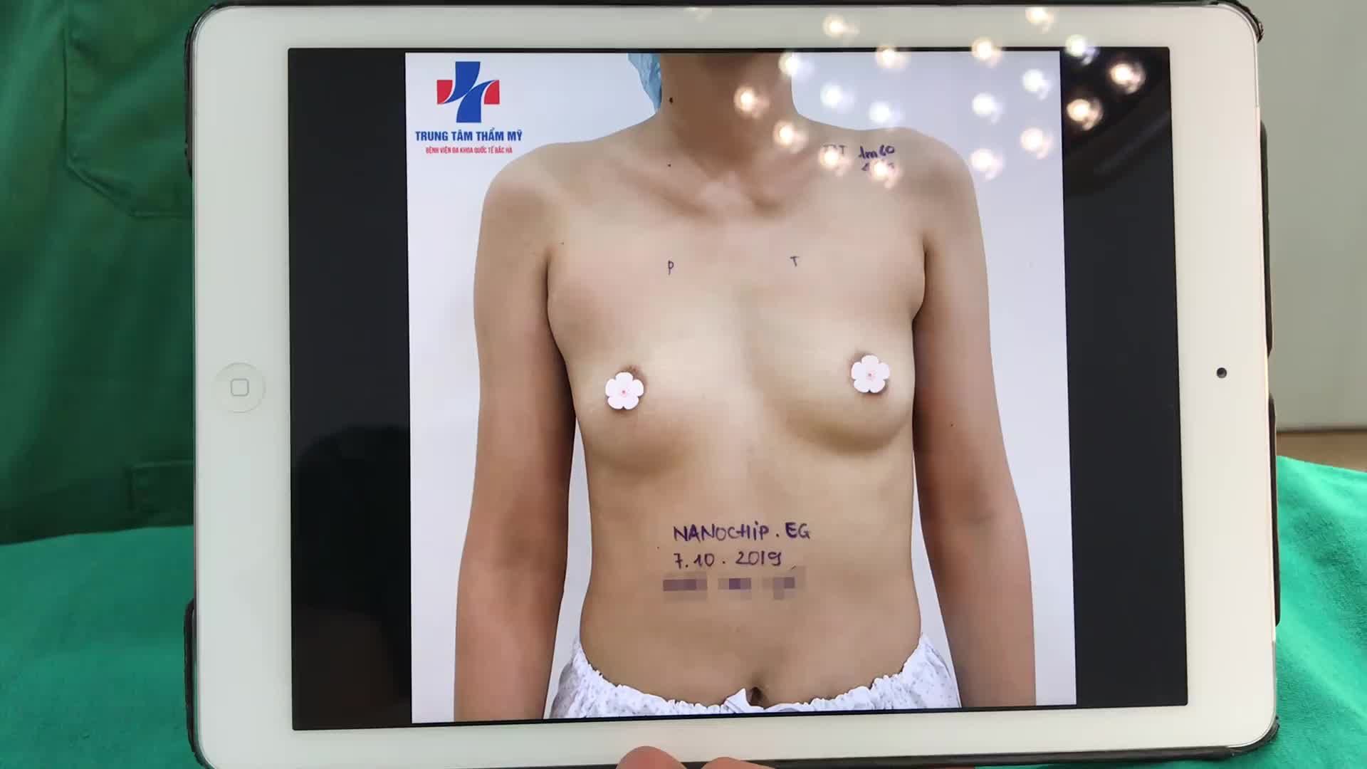 Khách hàng đến với thẩm mỹ bệnh viện Bắc Hà hôm nay sử dụng dịch vụ NÂNG CẤP VÒNG 1