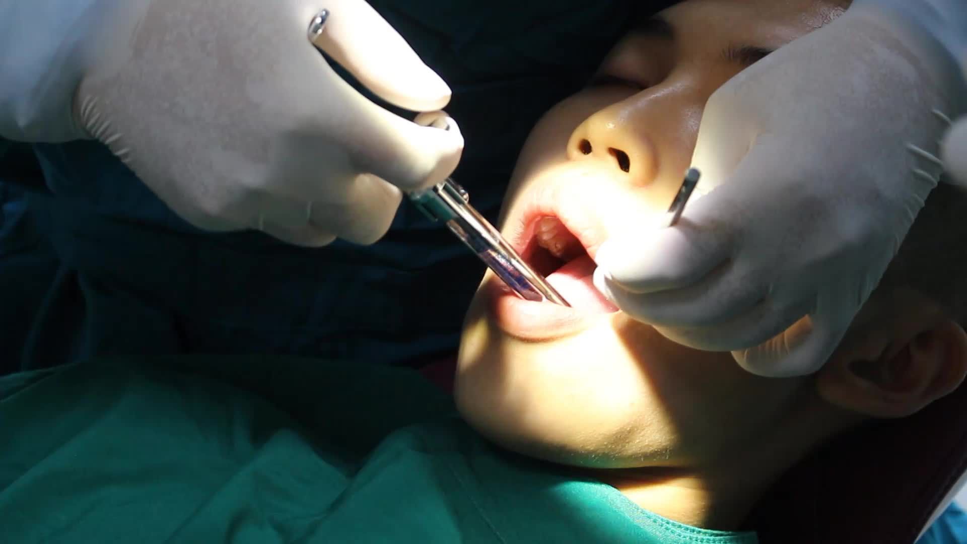 Case cấy ghép trụ Implant Korea (Dentium - Ostem) cho bệnh nhân Đ. T. H - 21 tuổi