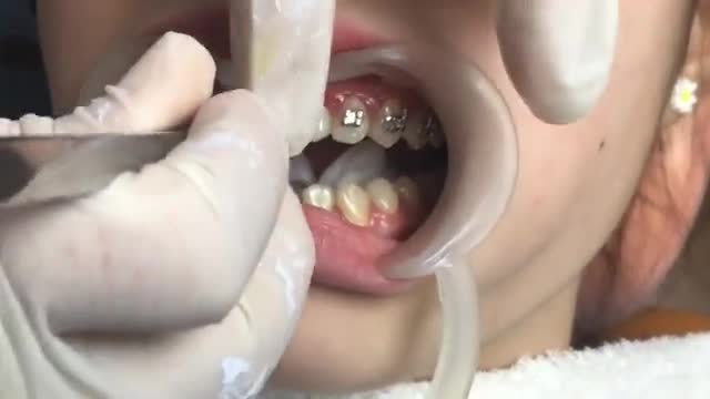 Có phải cứ niềng răng là sẽ phải nhổ răng