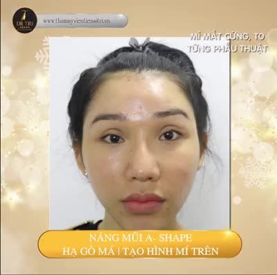 Gương mặt thon gọn, nữ tính ngay sau 1 ngày phẫu thuật hạ gò má, nâng mũi A-Shape và tạo hình mí trên