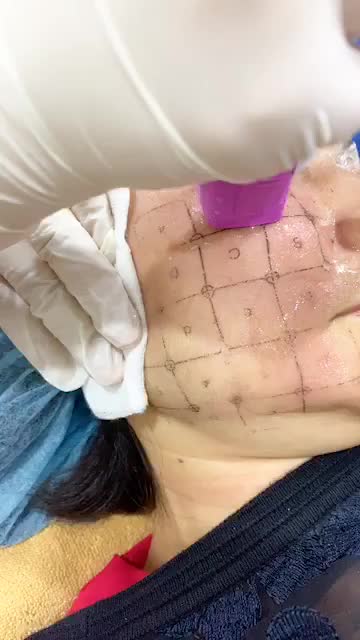 "HỒI XUÂN" VỚI "PHÙ THUỶ" THERMAGE FLX. CHỈ 1 LẦN - TRẺ HƠN 10 TUỔI SO VỚI THỰC TẾ