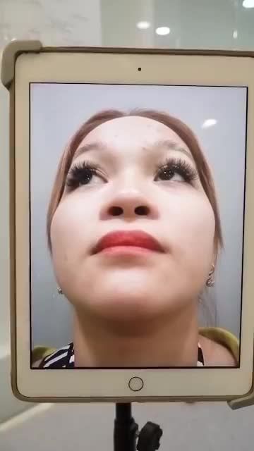 NÂNG MŨI CẤU TRÚC KẾT HỢP CHỈNH XƯƠNG VỪA ĐƯỢC DR HOẠT THỰC HIỆN XONG