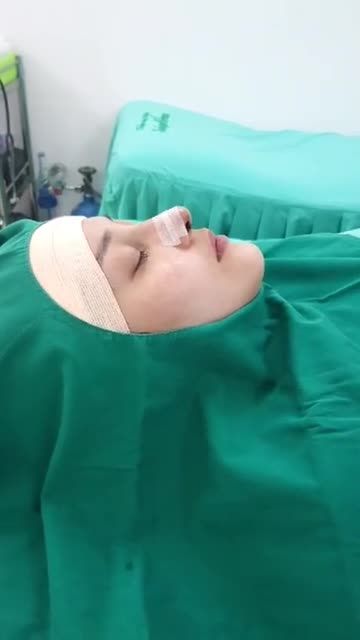 Nâng mũi cấu trúc Surgiform Dáng mũi xuất sắc luôn nha cả nhà