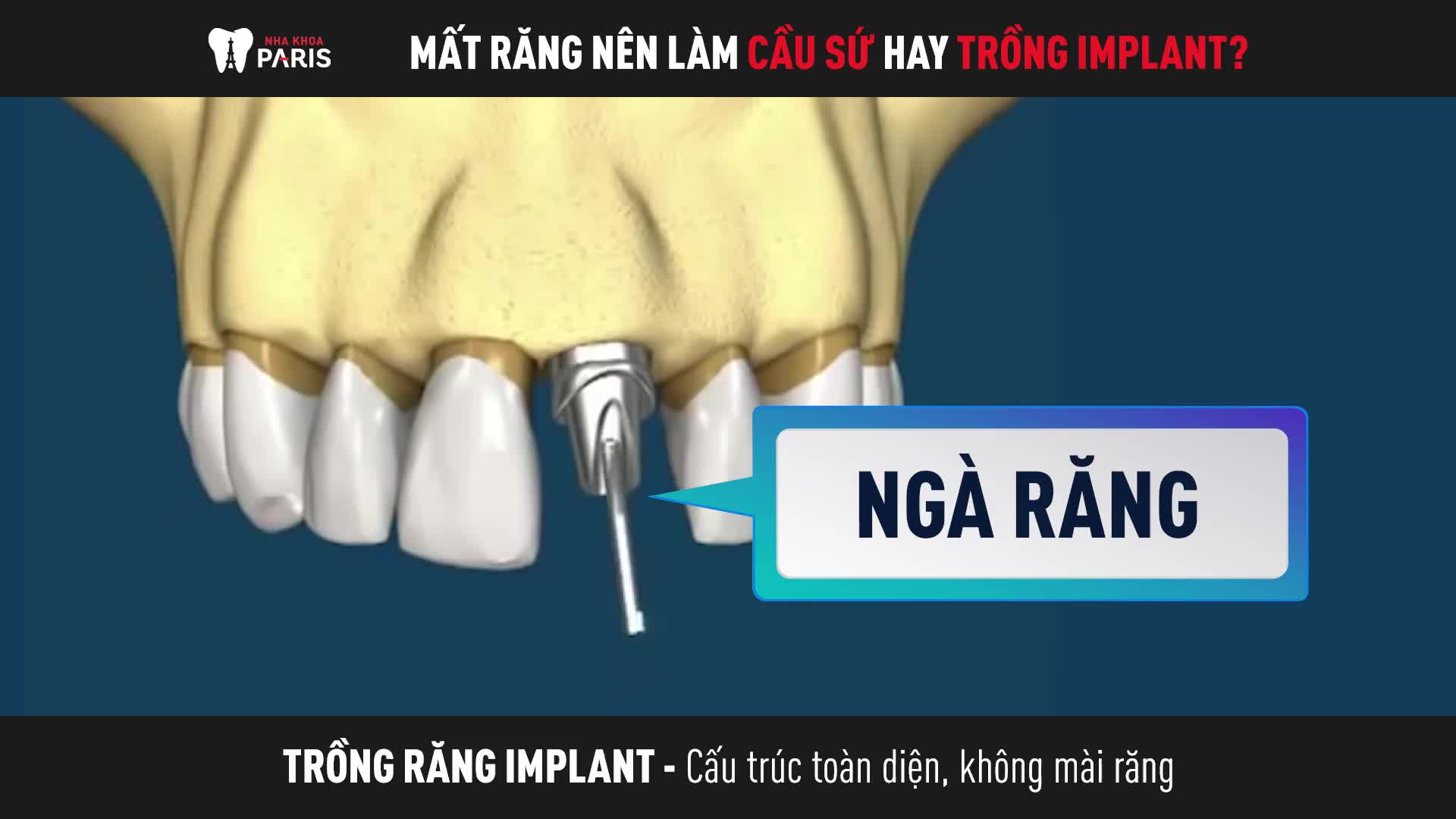 SO SÁNH CẦU RĂNG SỨ VÀ TRỒNG RĂNG IMPLANT