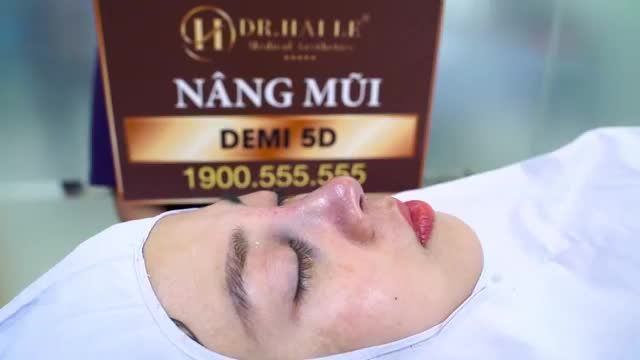 Cùng theo dõi kết quả đẹp hoàn hảo của một vị khách hàng sau khi nâng mũi Demi 5D tại Dr. Hải Lê