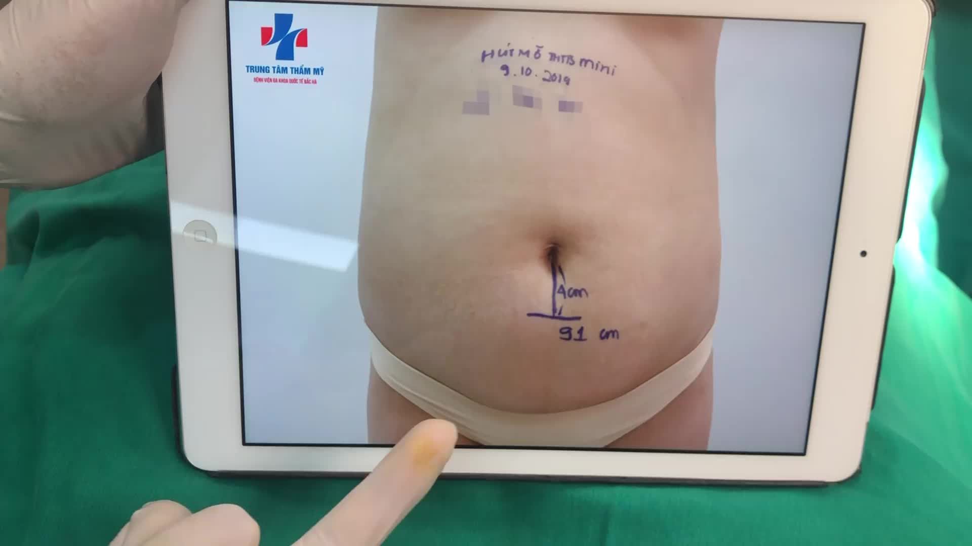 KẾT QUẢ HÚT MỠ VASERLIPO