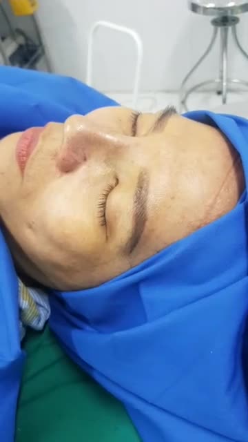 Nâng mũi cấu trúc đa lớp