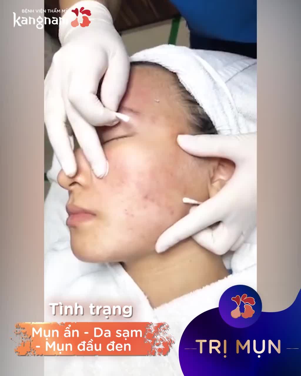 6 buổi - Hồi sinh khuôn mặt bị mụn tàn phá khi tới Kangnam