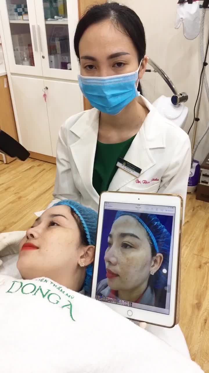 Đánh bay 60% gốc nám sau 3 buổi điều trị bằng công nghệ Bio Melasma