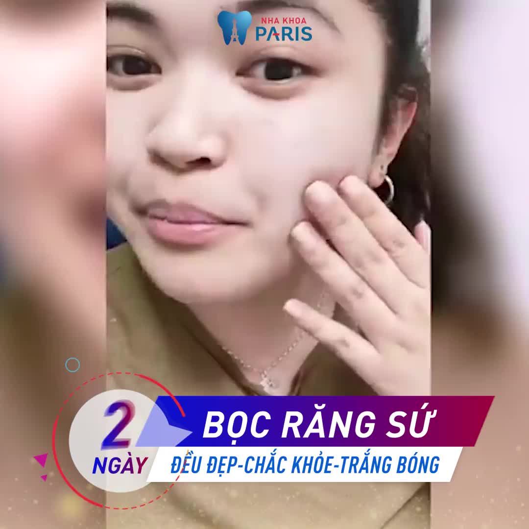 Chỉnh Răng Cửa Thưa Mà Không Cần Niềng Răng