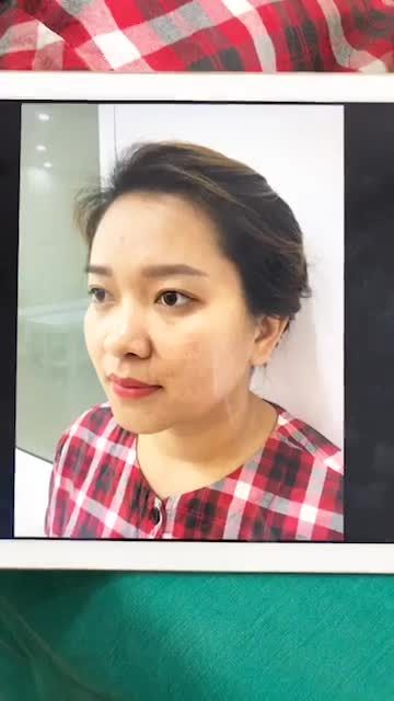 kết quả sau khi nâng mũi Sline cho chị khách hàng đến từ Yên Bái.