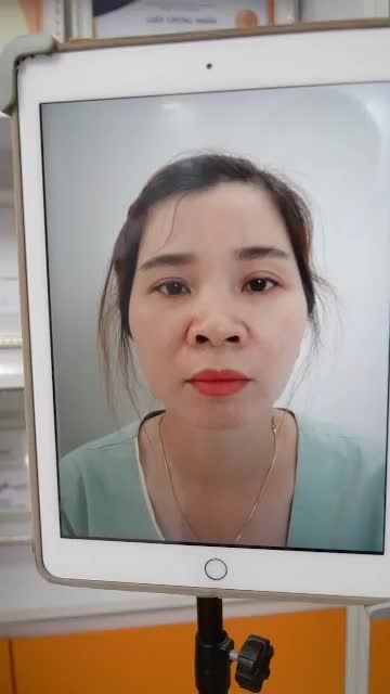 NÂNG MŨI CẤU TRÚC SỤN SUGIRFORM TẠI DR HOẠT – SỞ HỮU NGAY MŨI ĐẸP