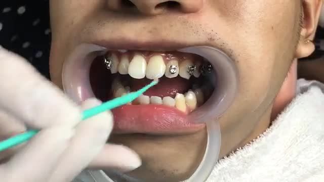NIỀNG RĂNG điều trị Răng HÔ CHÌA