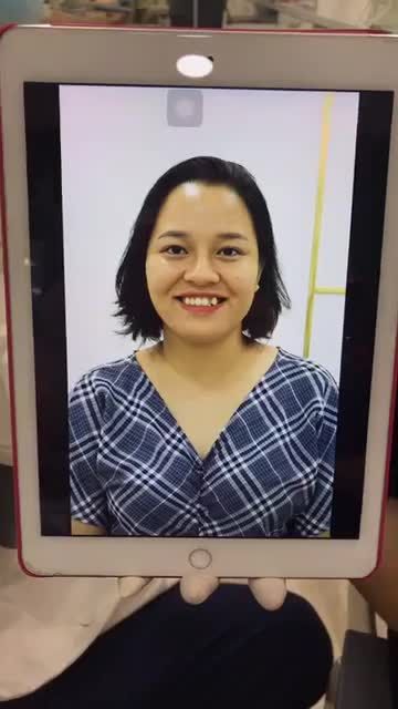 Sở hữu nụ cười duyên dáng sau khi thẩm mỹ 20 răng HT Full