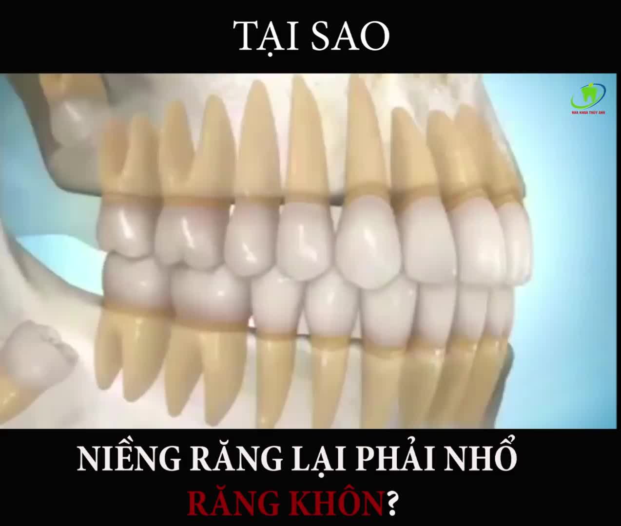 TẠI SAO NIỀNG RĂNG LẠI PHẢI NHỔ RĂNG KHÔN