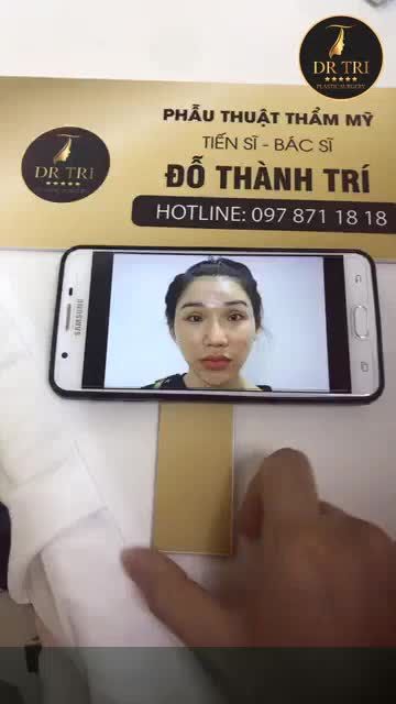 Mời các bạn cùng theo dõi hình ảnh của chị khách hàng thực hiện phẫu thuật hạ gò má, nâng mũi A Shape và tạo hình mí trên sau 3 ngày nhé