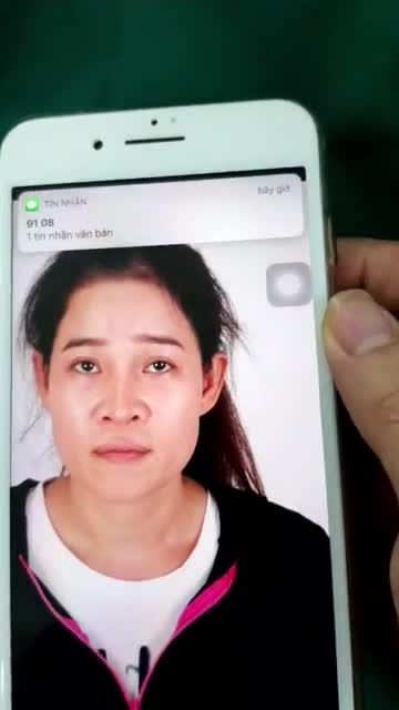 Nâng mũi Sform Plus cân thái dương dành cho mũi sửa lại